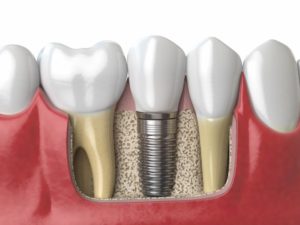 anatomy-of-healthy-teeth-and-tooth-dental-implant--PAF6ZMW (1)