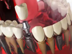 tooth implant in the model human teeth gums and de PZHNUNM 1