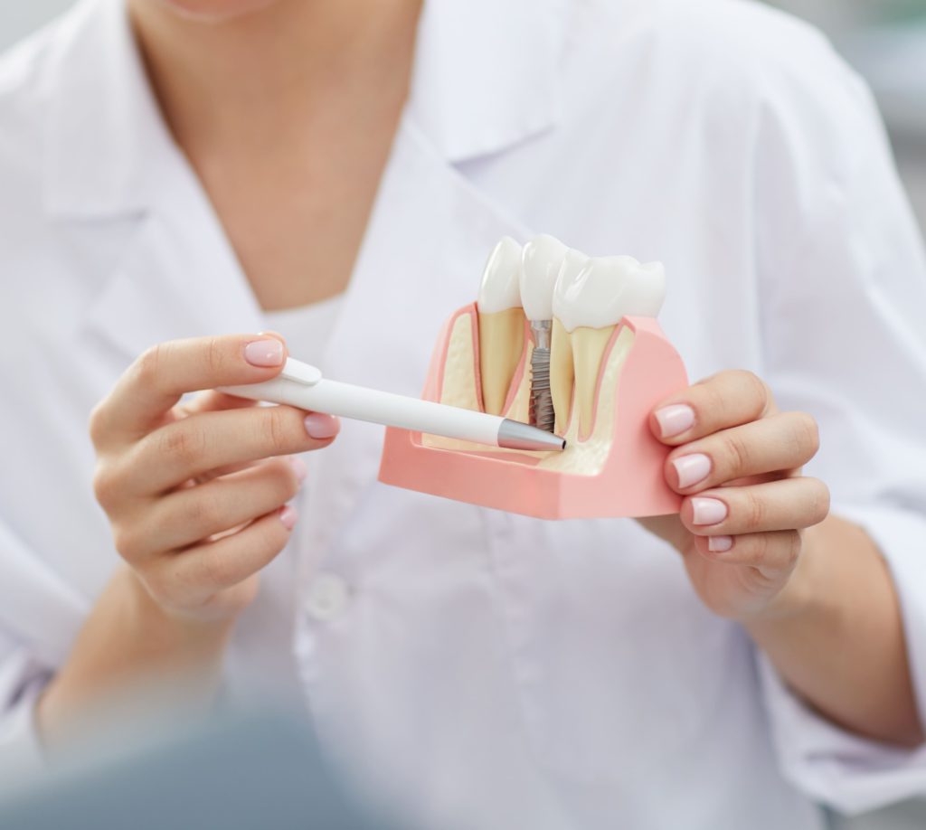 dentist explaining tooth implantation process 2021 09 24 03 53 47 utc 1 1