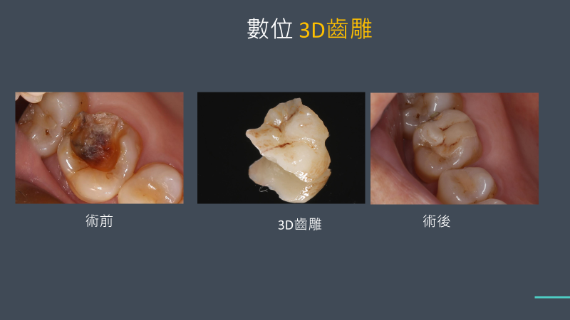 3d齒雕