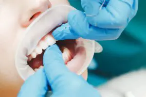 close up of female mouth with retractor doctor fl 2022 02 01 23 40 15 utc 1
