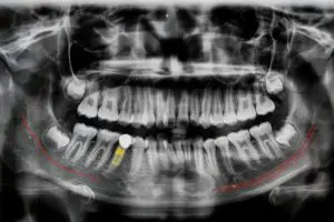digital x ray of jaw with implant tooth 2021 08 30 18 50 07 utc 2