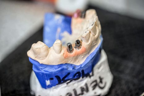 dental implants 2021 08 26 17 52 15 utc