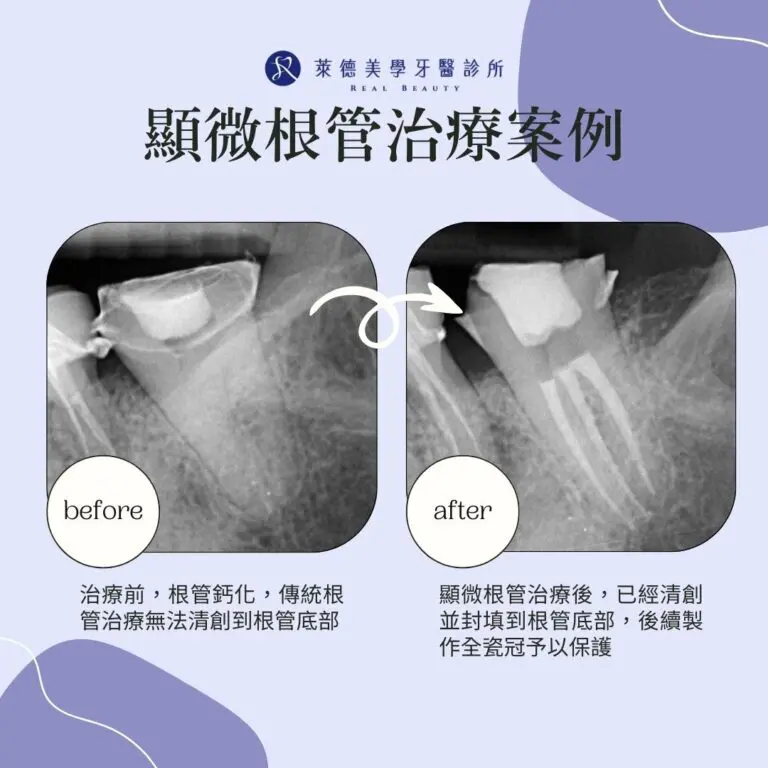 顯微根管治療案例