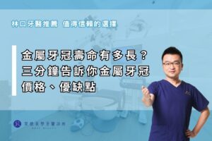 金屬牙冠壽命有多長？三分鐘告訴你金屬牙冠價格、優缺點