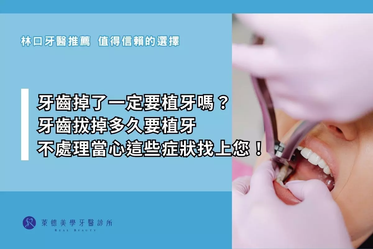 牙齒掉了一定要植牙嗎？ 牙齒拔掉多久要植牙 不處理當心這些症狀找上您！