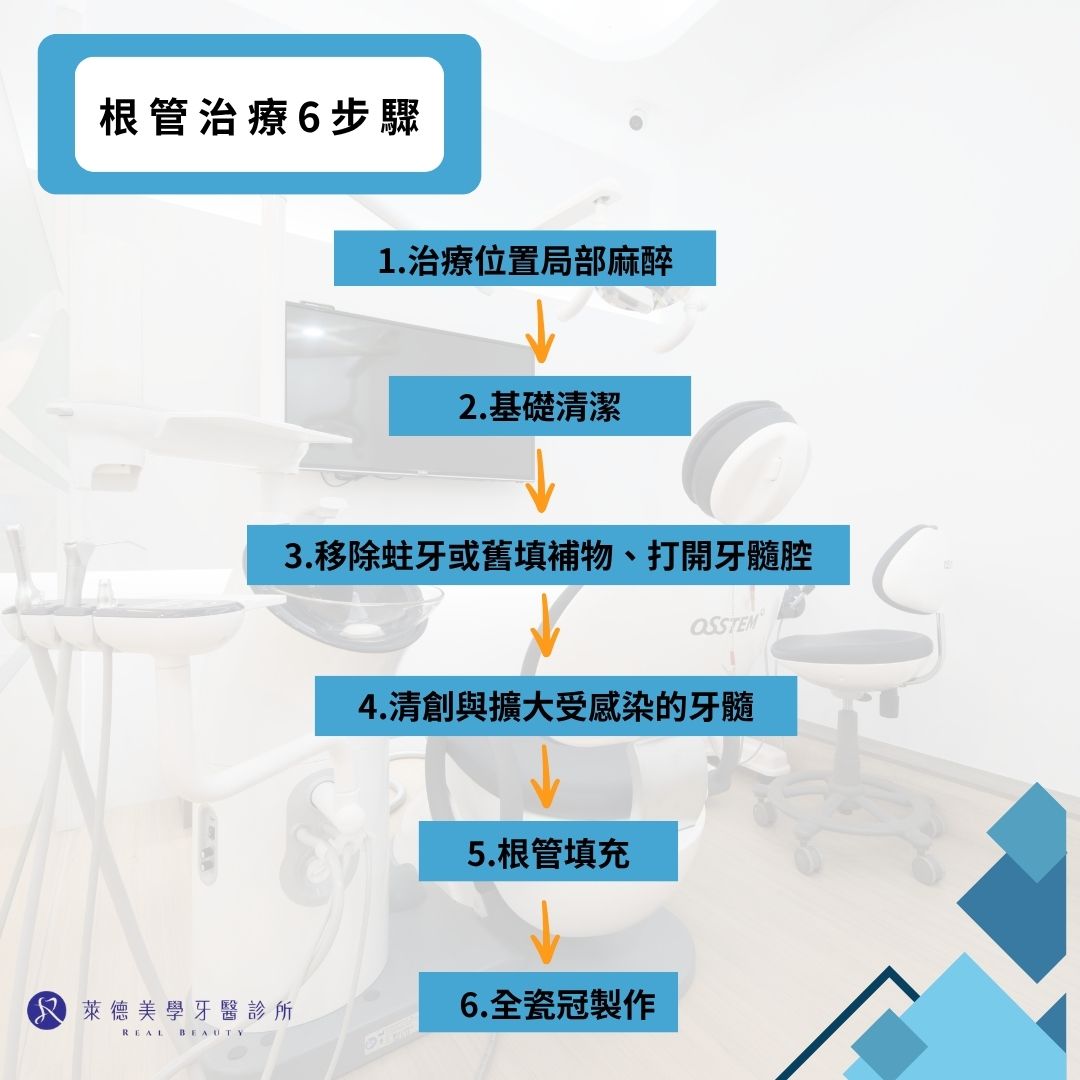 根管治療流程、根管治療缺點,林口萊德牙醫3分鐘說清楚! 1 根管治療6步驟