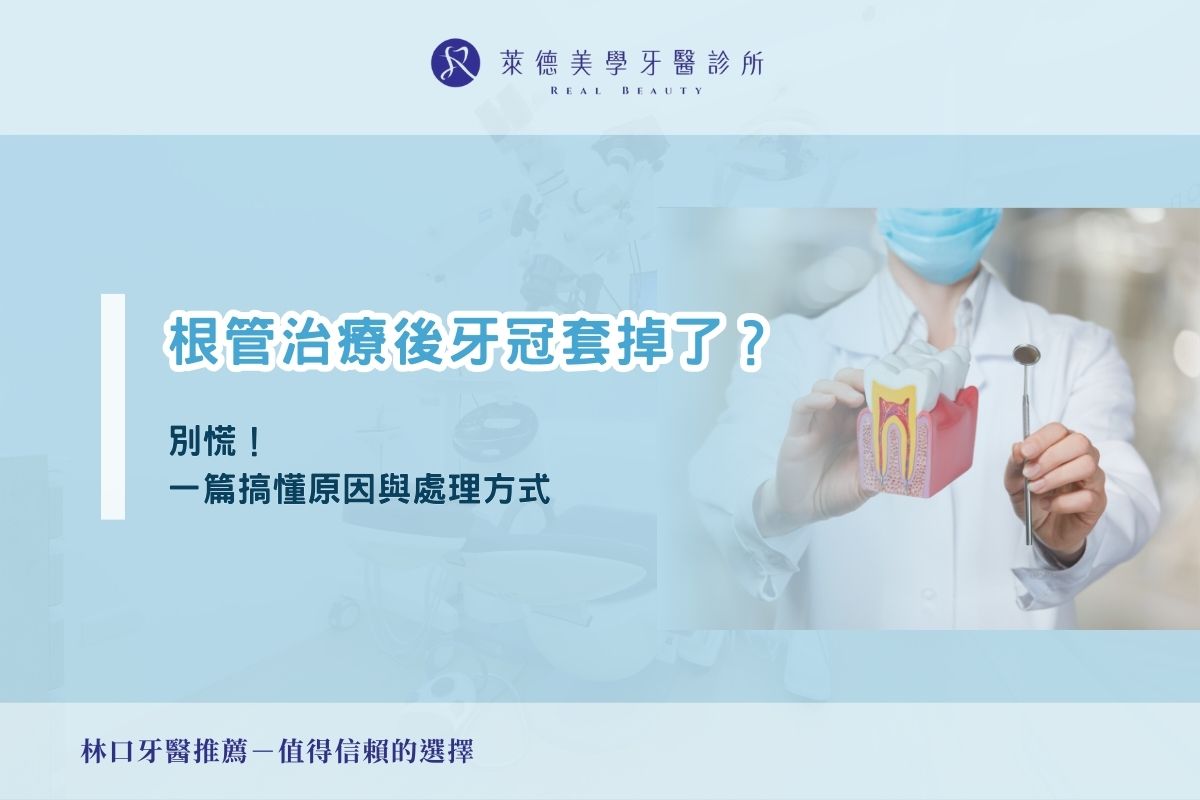 根管治療後牙冠套掉了？別慌！一篇搞懂原因與處理方式