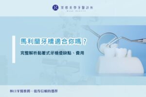 馬利蘭牙橋適合你嗎？完整解析黏著式牙橋優缺點、費用