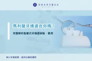 馬利蘭牙橋適合你嗎？完整解析黏著式牙橋優缺點、費用