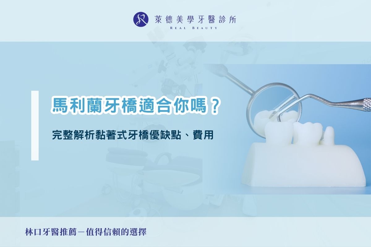 馬利蘭牙橋適合你嗎？完整解析黏著式牙橋優缺點、費用