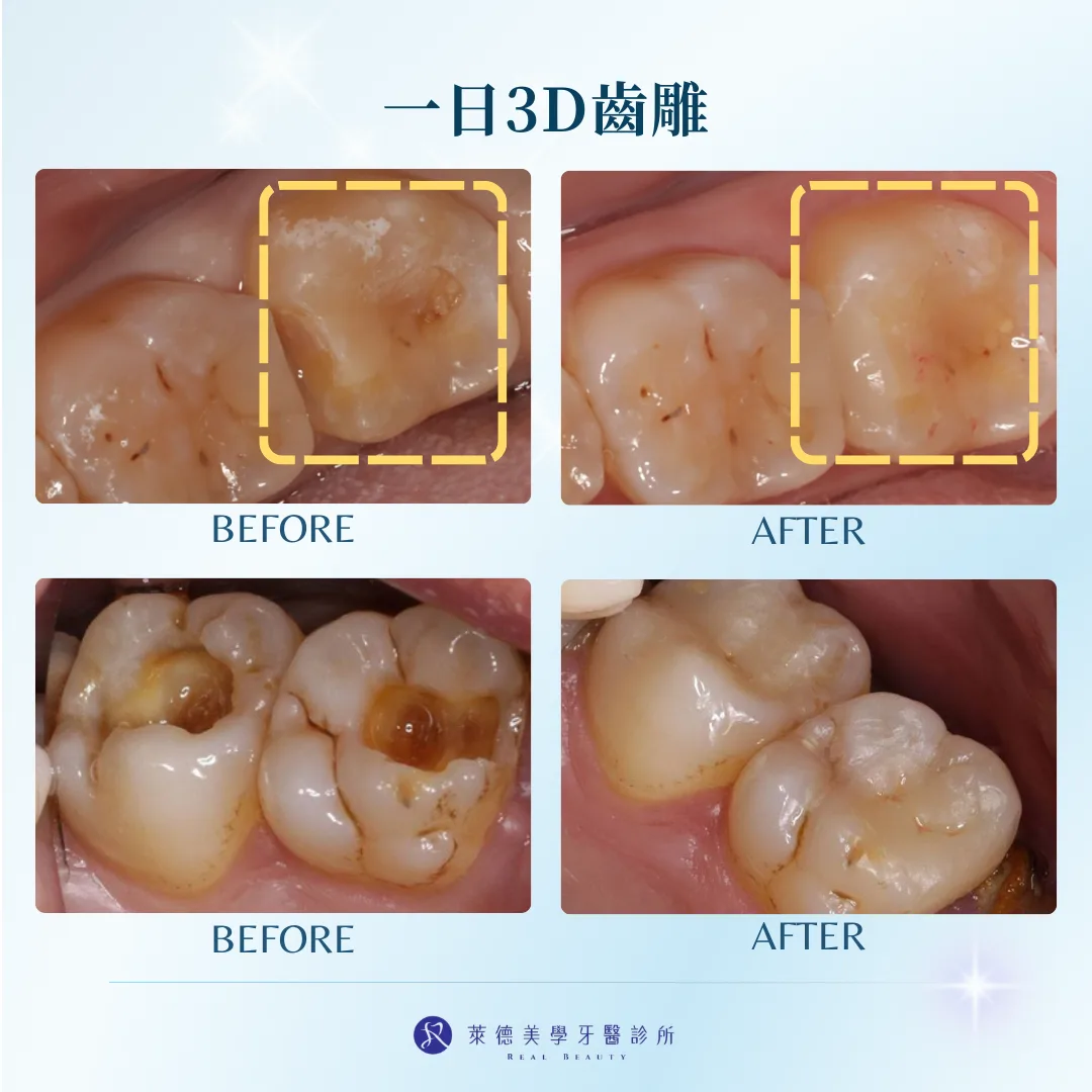 3D齒雕照片