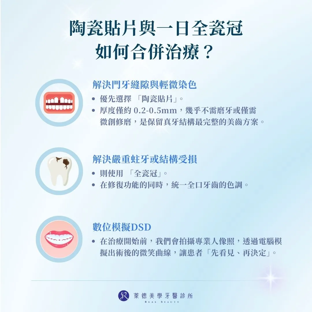 陶瓷貼片與一日全瓷冠如何合併治療？