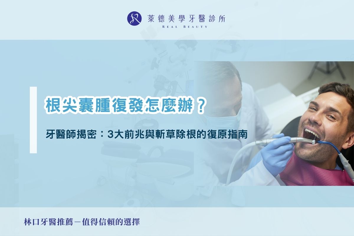 根尖囊腫復發怎麼辦？牙醫師揭密：3 大前兆與斬草除根的復原指南