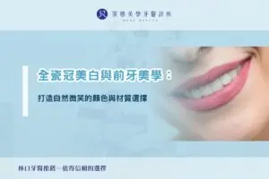 全瓷冠美白與前牙美學：打造自然微笑的顏色與材質選擇