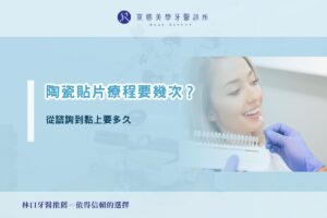 陶瓷貼片療程要幾次？從諮詢到黏上要多久
