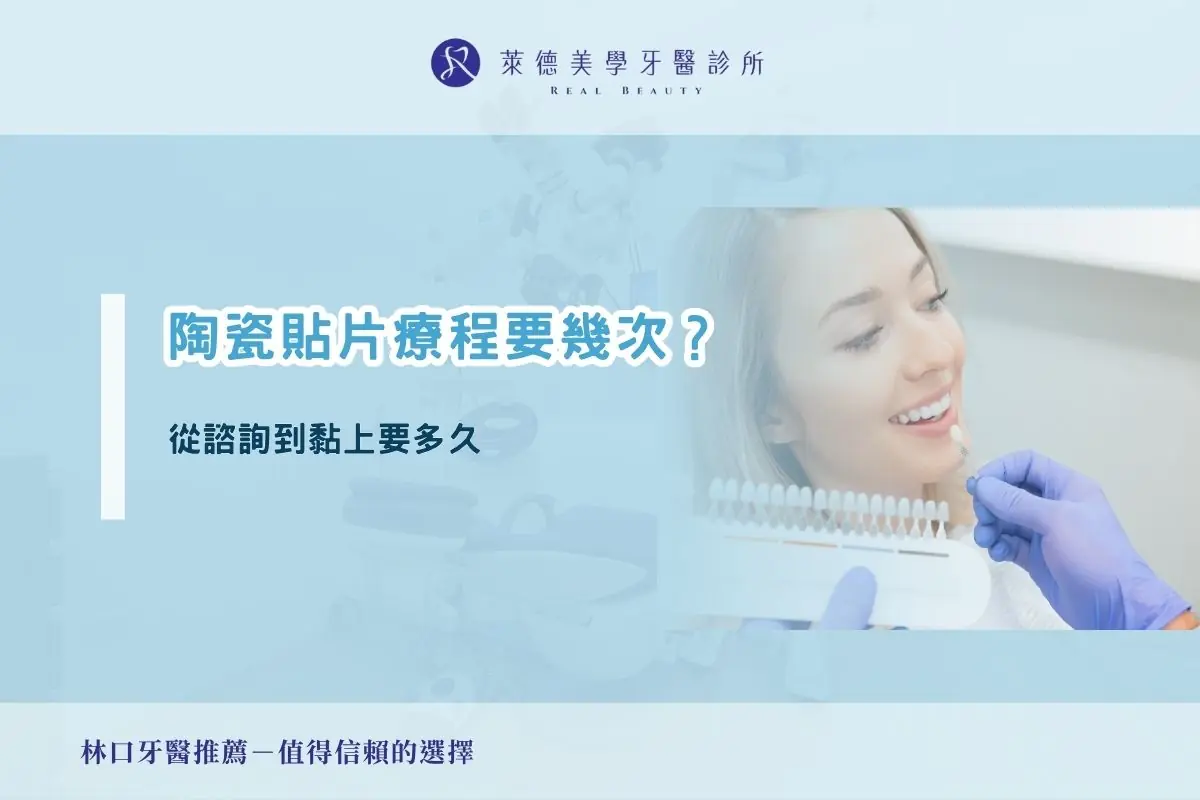 陶瓷貼片療程要幾次？從諮詢到黏上要多久