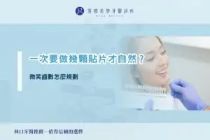 一次要做幾顆貼片才自然？微笑齒數怎麼規劃