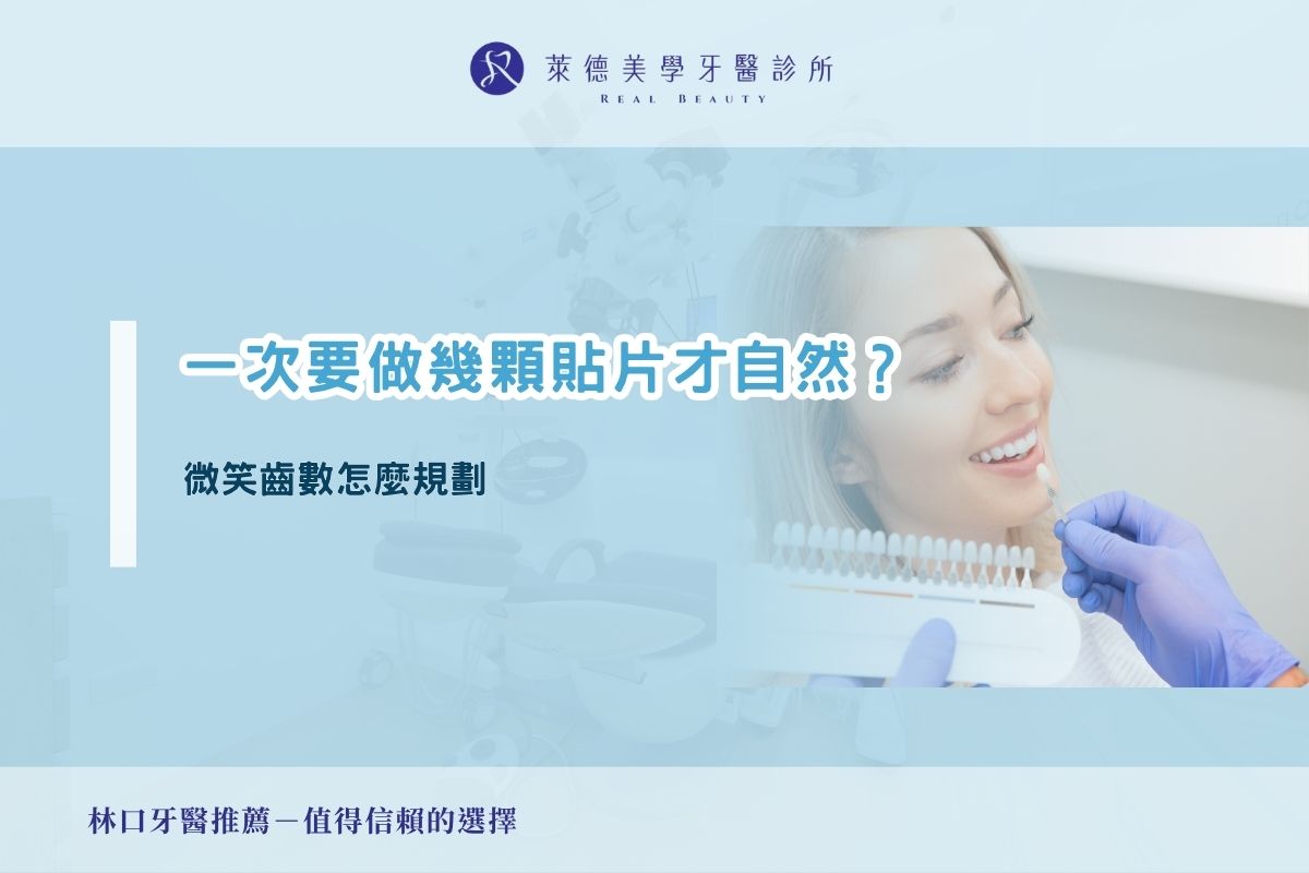 一次要做幾顆貼片才自然？微笑齒數怎麼規劃