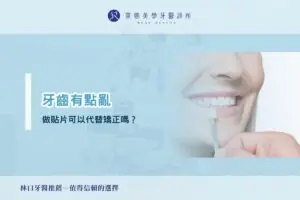 牙齒有點亂,做貼片可以代替矯正嗎?
