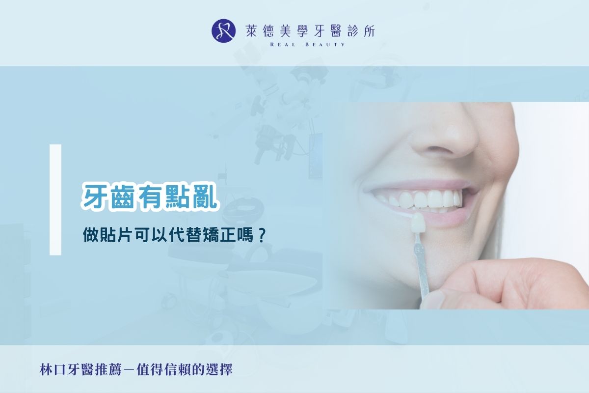 牙齒有點亂，做貼片可以代替矯正嗎？