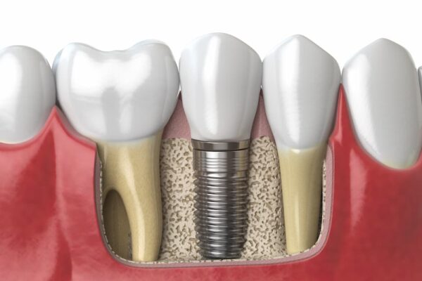 anatomy-of-healthy-teeth-and-tooth-dental-implant--PAF6ZMW (1)