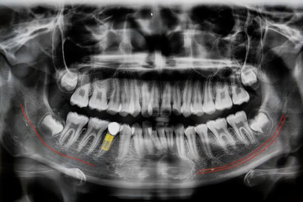 digital-x-ray-of-jaw-with-implant-tooth-2021-08-30-18-50-07-utc (2)