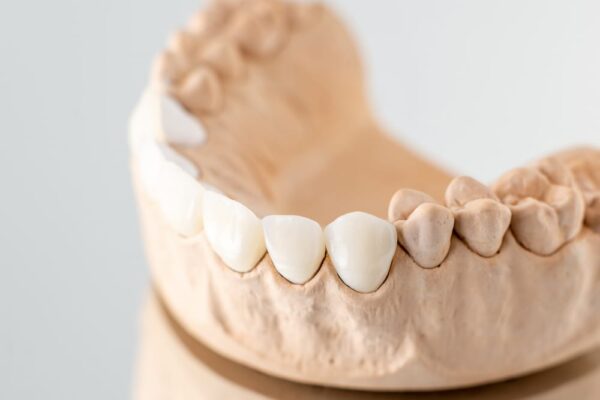 model-of-artificial-jaw-with-veneers-2021-09-01-15-22-43-utc