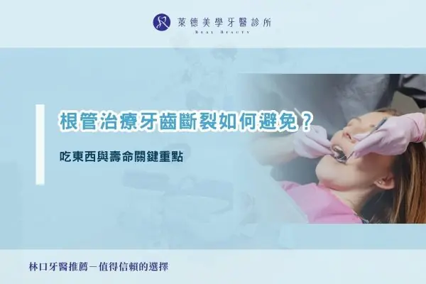 根管治療牙齒斷裂如何避免？吃東西與壽命關鍵重點
