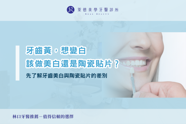 teeth-whitening-vs-porcelain-veneers