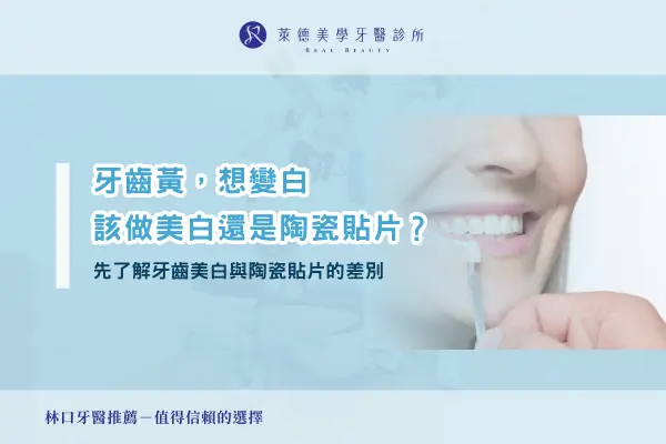 teeth-whitening-vs-porcelain-veneers
