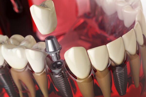 tooth-implant-in-the-model-human-teeth-gums-and-de-PZHNUNM (1)